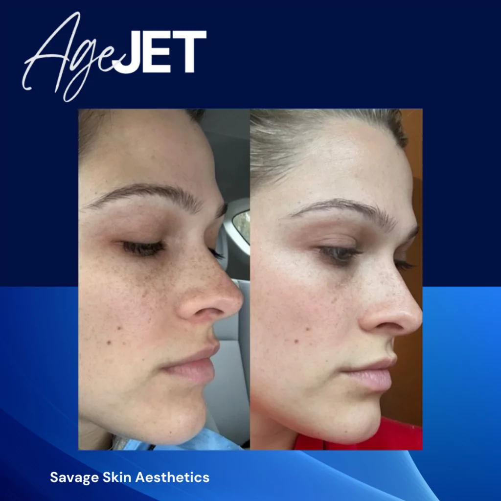 RT Aesthetics Whickham AgeJet Plasma