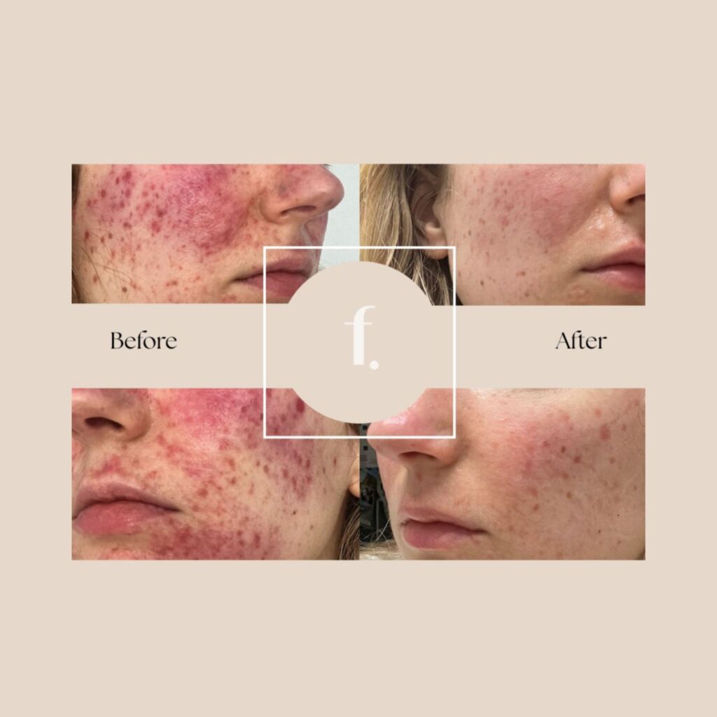 Struggling with bloating, fatigue or hormone imbalances? Freya Clinic’s Ultimate Gut and Hormone Reset Package could be the answer
