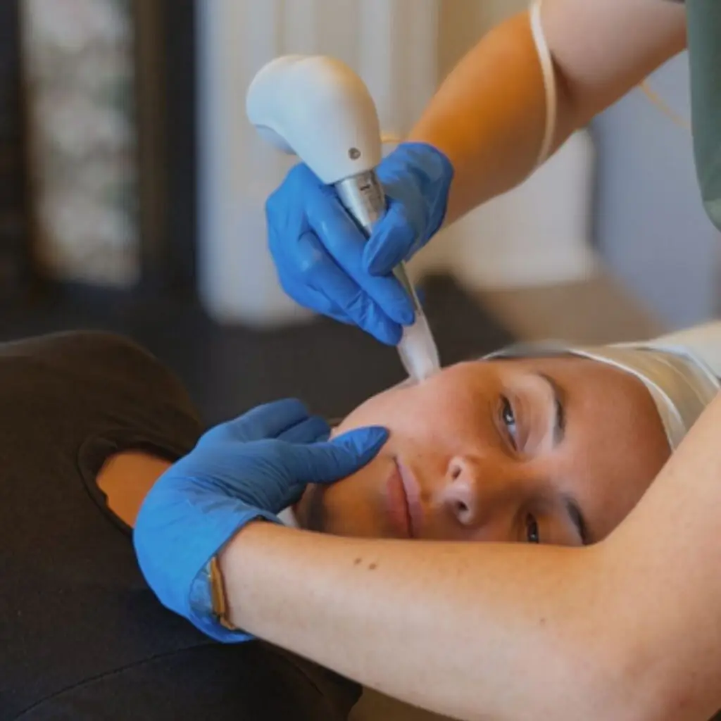 Rhoē Wellness Clinic - Jesmond - Microneedling